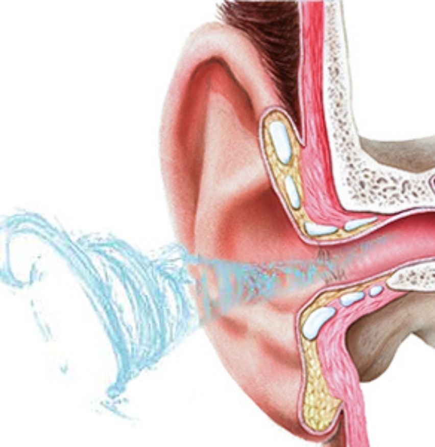 Ear Washer and Ear Irrigation Kit: image 7